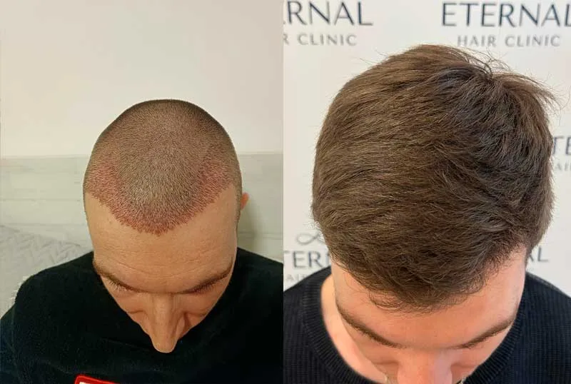 Comparación de injerto capilar en zona frontal con cabeza rasurada y resultado final