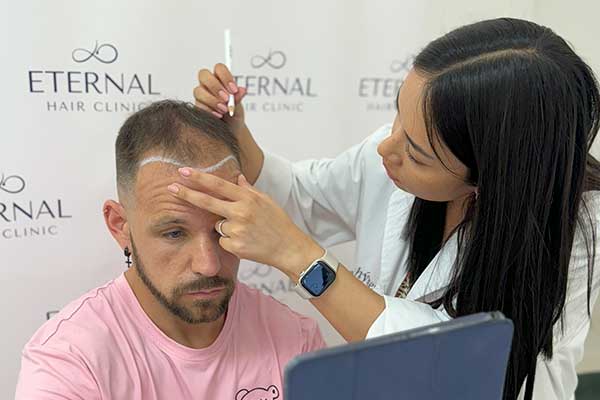 Dra. Nicole Quijahuaman Arteta diseñando línea frontal para injerto capilar en paciente masculino
