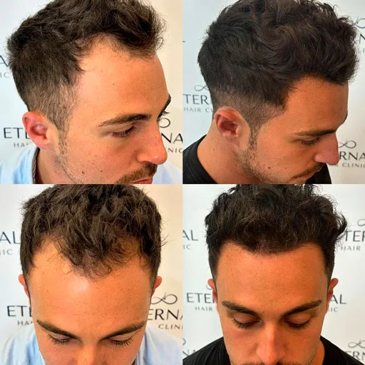 Antes y después de injerto capilar en paciente joven en Eternal Hair Clinic Barcelona