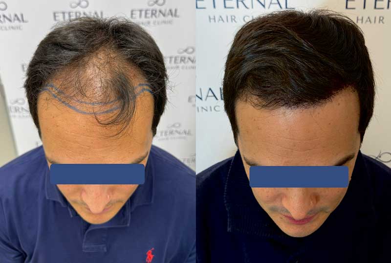 Injerto capilar con diseño quirúrgico previo y resultado final en la línea frontal