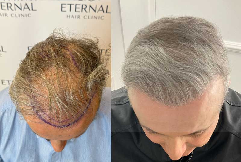 Comparación de injerto capilar en paciente con cabello canoso – diseño y resultado