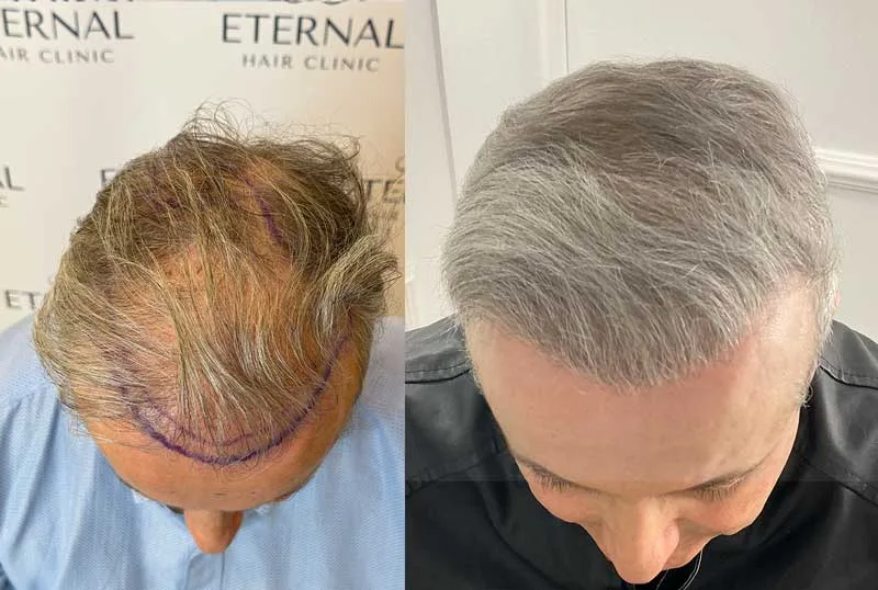 Comparación de injerto capilar en paciente con cabello canoso – diseño y resultado