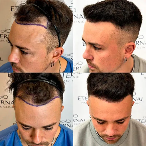 Antes y después de injerto capilar frontal en Eternal Hair Clinic Barcelona