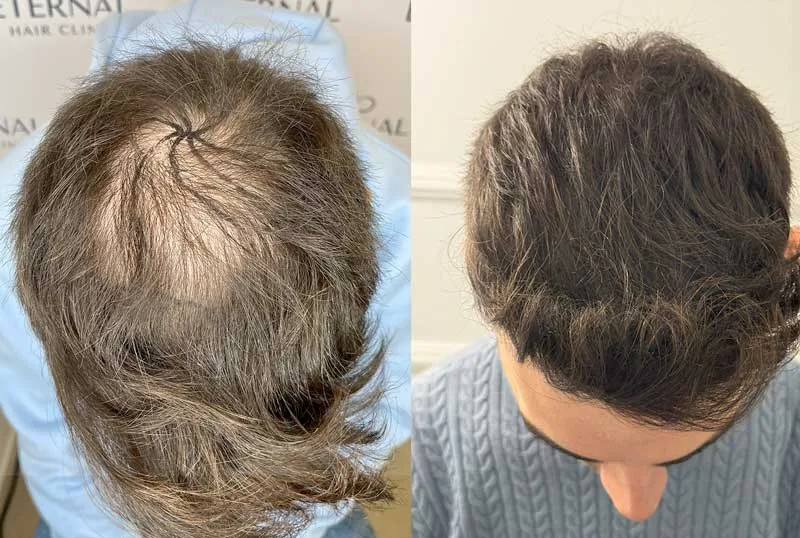 Comparación antes y después de injerto capilar en la coronilla – Eternal Hair Clinic