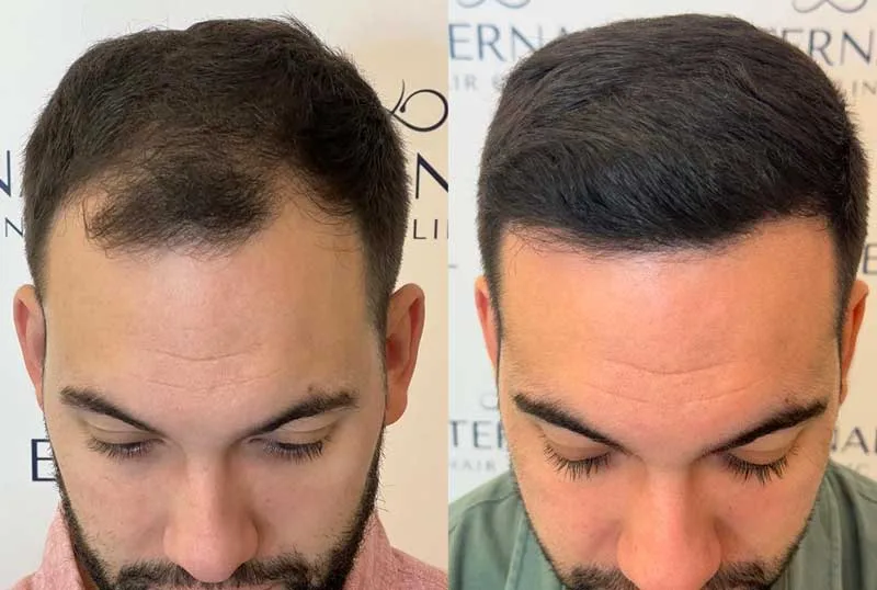 Resultado del injerto capilar en entradas y zona frontal – antes y después