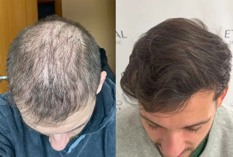 Comparativa antes y después de injerto capilar en zona superior – Eternal Hair Clinic