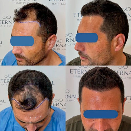 Evolución injerto capilar FUE Zafiro antes y después en Eternal Hair Clinic Barcelona