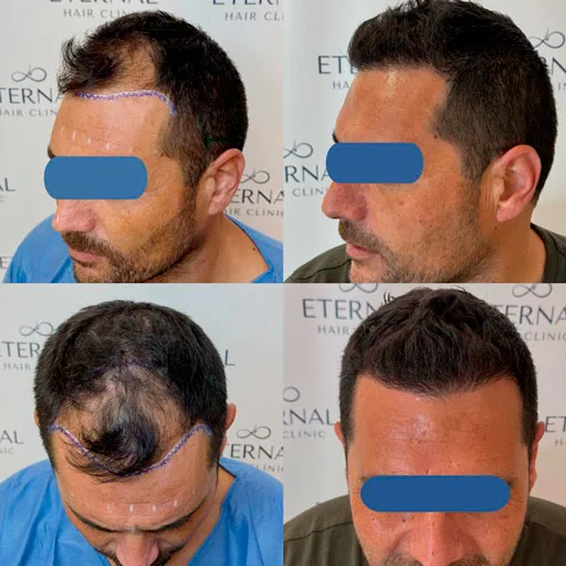 Evolución injerto capilar FUE Zafiro antes y después en Eternal Hair Clinic Barcelona