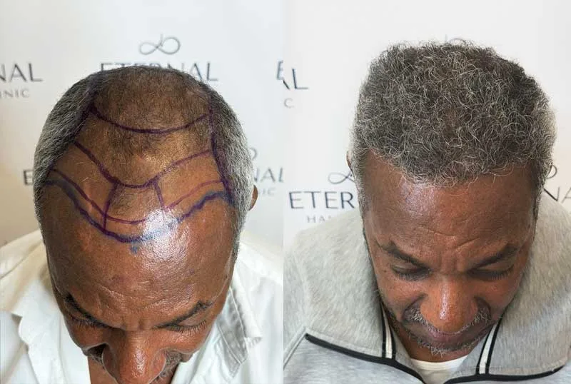 Comparación antes y después de injerto capilar en paciente con cabello canoso y diseño marcado