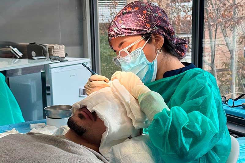 Procedimiento de trasplante capilar realizado por especialista en clínica capilar