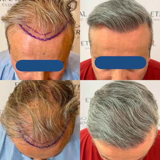 Antes y después de injerto capilar en paciente con cabello canoso – técnica FUE Zafiro