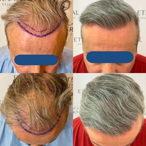 Antes y después de injerto capilar en paciente con cabello canoso – técnica FUE Zafiro