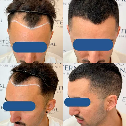 Antes y después de injerto capilar para entradas pronunciadas en paciente joven