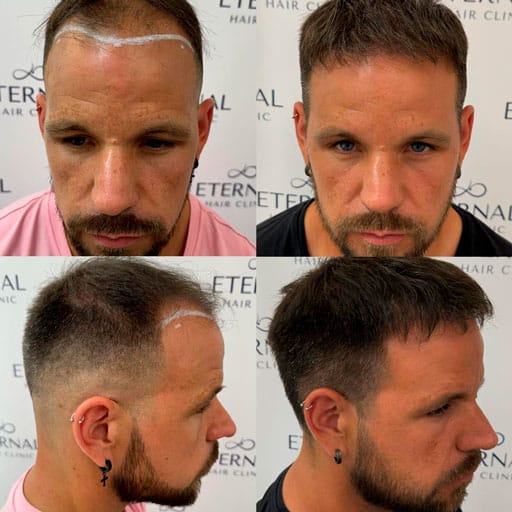 Resultado natural tras injerto capilar FUE Zafiro en paciente con línea frontal definida