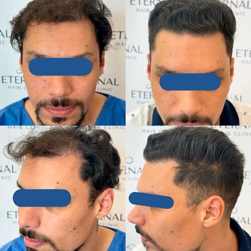 Antes y después de injerto capilar en zona frontal y entradas laterales