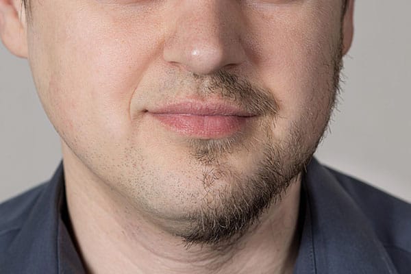 Pérdida de barba y bigote en hombre