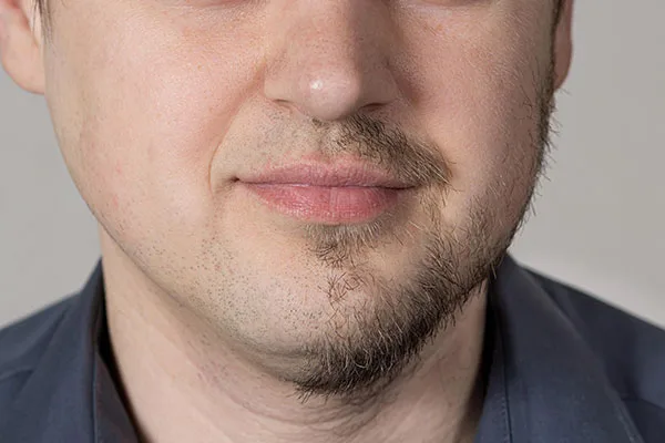 Pérdida de barba y bigote en hombre